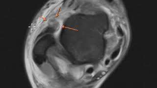 Anterior talofibular ligament tear and posterior tibial tendon tear [upl. by Niliac]