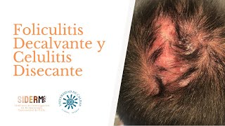 Revisión Foliculitis Decalvante y Celulitis Disecante [upl. by Reinnej]