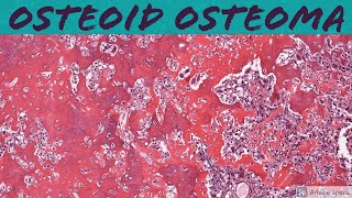 Osteoid Osteoma Bone Pathology Basics [upl. by Noteloc]