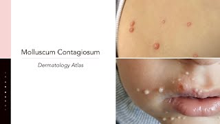 Molluscum Contagiosum [upl. by Leirua677]