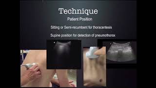 US Guided thoracentesis CUSE 2018 [upl. by Hsitirb]