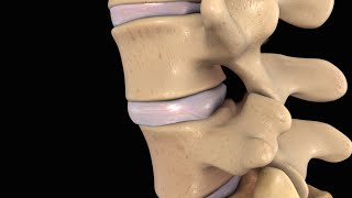 Back Pain Lumbar Disc Injury [upl. by Hauge]