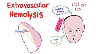 Extravascular Hemolysis [upl. by Bolger]