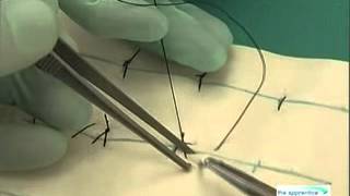 Continuous Interlocking Sutures [upl. by Faden]