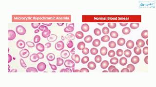 microcytic hypochromic anemia [upl. by Adeuga]