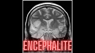 ENCEPHALITE [upl. by Eckblad]