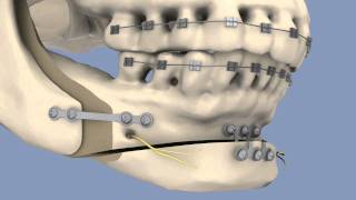 BSSO amp Osseous Genioplasty [upl. by Koziara448]