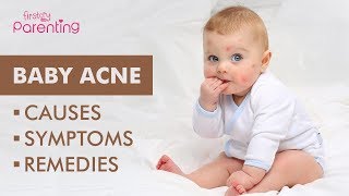 Baby Acne – Causes Symptoms amp Treatment [upl. by Ahsinut922]