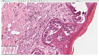 Ductal carcinoma in situ DCIS and Paget Disease  Histopathology [upl. by Manley]