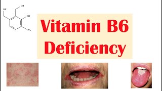 Vitamin B6 Pyridoxine Deficiency  Dietary Sources Causes Signs amp Symptoms Diagnosis Treatment [upl. by Demakis]