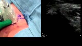 Lateral Femoral Cutaneous Nerve Block  In Plane Approach [upl. by Trill]