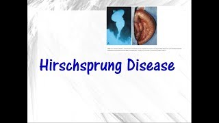 Hirschsprung disease [upl. by Frederique]