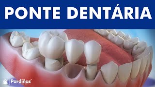 Prótese dentária fixa  Ponte © [upl. by Kra]