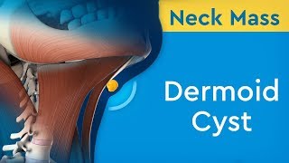 Understanding Squamous Cell Carcinoma [upl. by Edrick]