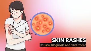 Skin Rash Causes Signs and Symptoms Diagnosis and Treatment [upl. by Alieka533]