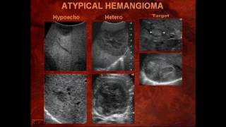 Sonography of Liver Masses [upl. by Yrrol338]