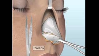 Rinoplastia abierta [upl. by Pearlstein165]