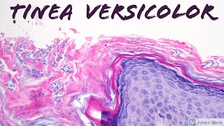 Tinea VersicolorPityriasis Versicolor Malassezia aka Pityrosporum Skin Infection Dermatology [upl. by Teteak]