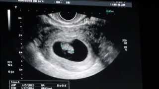 8 Weeks Ultrasound [upl. by Ilime]