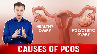 3 Causes of Polycystic Ovarian Syndrome PCOS amp High Androgens – Dr Berg [upl. by Ninnetta]