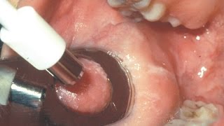 Biopsia de la mucosa bucal T26 [upl. by Okwu]