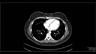 Abdominal Anatomy on Computed Tomography [upl. by Erie266]