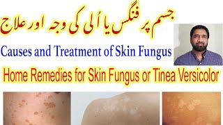 Fungal Skin Infection  Fungal Infection  Tinea Versicolor Treatment  Skin Fungus Yeast Infection [upl. by Dorina493]