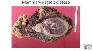 Breast Mammary Pagets disease [upl. by Breger]