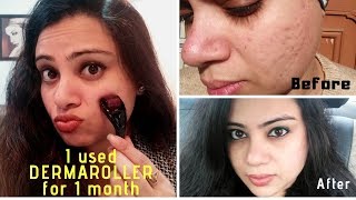 How to Use a Derma Roller for Acne Scars  Micro Needling  Before amp After  Madams Choice [upl. by Caraviello]