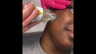 Treating Folliculitis and Hyperpigmentation With Laser Hair Reduction by the Lumenis Splendor X [upl. by Ardelle220]