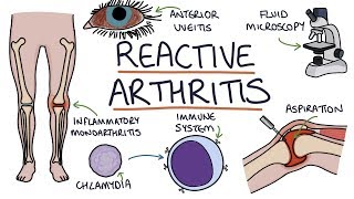 Understanding Reactive Arthritis [upl. by Atikan]