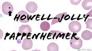 Pappenheimer Bodies amp HowellJolly Bodies Peripheral Blood Smear Hematology amp Hematopathology [upl. by Oinimreh]