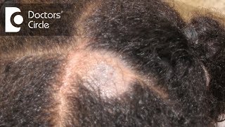 What causes Scalp Ringworm Effective Treatment   Tinea Capitis  Dr Tina Ramachander [upl. by Ellerret]