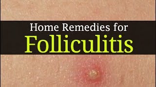 10 Home Remedies for Folliculitis and Best Home Treatment methods [upl. by Radloff]