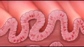 Barretts Esophagus  Pathology Dysplasia and Carcinoma [upl. by Mloclam]