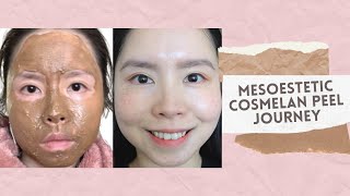 Cosmelan Treatment by Mesoestetic  Removal of Freckles Melasma amp Pigmentation [upl. by Marozik]