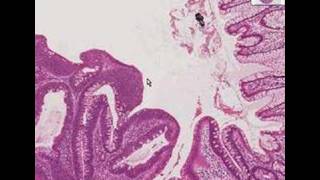 ICD10CM Coding Demonstration using Neoplasm Table [upl. by Aneet]