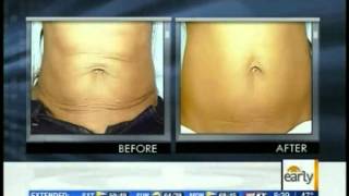 Exilis Body Contouring  Ultrasound Fat Reduction  Exilis Day [upl. by Ardnoek]