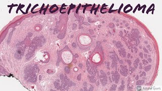 Trichoepithelioma 101 [upl. by Schlesinger]