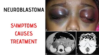 NEUROBLASTOMA Symptoms Signs Causes Treatment [upl. by Atekehs]