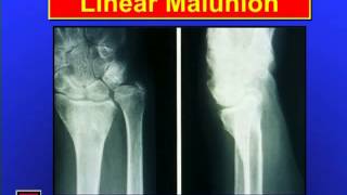 Distal Radius Fractures [upl. by Ahsieyt]