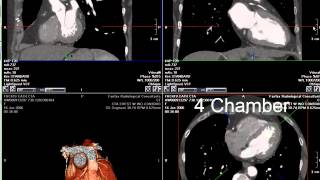 Coronary CT Angiography RCA Stenosis [upl. by Pepper]