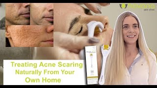 How To Properly Treat Acne Scaring  Dermaroller Breakdown [upl. by Lefkowitz491]