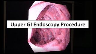 Upper GI Endoscopy Procedure in the ED [upl. by Ishmul]