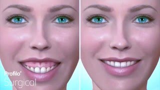 Le Fort I  Gummy Smile amp Upper Jaw Reduction [upl. by Bose]