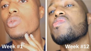 Minoxidil Beard Journey 3 Month Transformation [upl. by Fairlie]