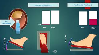 Basics of Phaco  Part I for Part II httpswwwyoutubecomwatchvUY6ZdPKPaJ4 quickguideorg [upl. by Blinnie425]