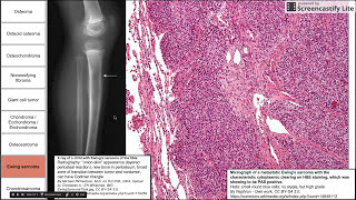 Bone and cartilage tumors [upl. by Aicilehp991]