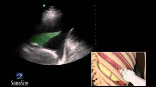 How To Ultrasound Guided Thoracentesis Exam 3D Video [upl. by Nileuqay]