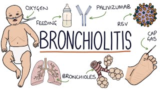 PART I  Pneumonia Overview Lobar and Bronchopneumonia [upl. by Ellak]